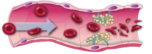 Diagramme zur Darstellung des Blutflusses unter normalen Bedingungen und der Bildung eines Blutgerinnsels bei TTP (Thrombotisch-thrombozytopenische Purpura)