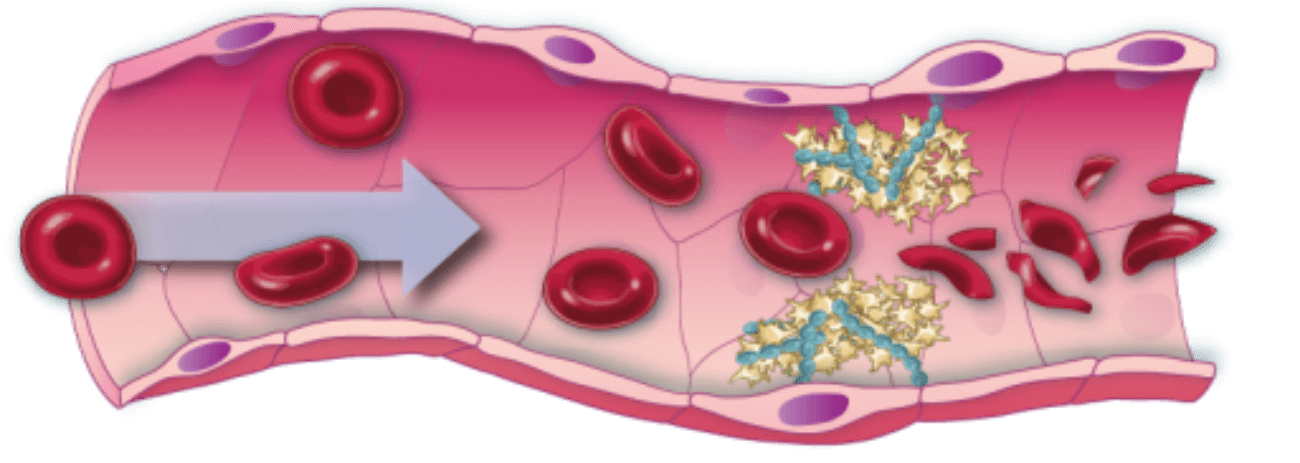 Diagrammi che illustrano il flusso sanguigno in condizioni normali e la formazione di un coagulo di sangue in caso di PTT (Porpora trombotica trombocitopenica)